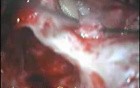 Cholesteatoma - Canal Up Mastoidectomy Incision - Part 2 - Grafting, Ossiculoplasty