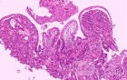 Ovarian Carcinoma Metastatic to Stomach and Duodenum (15 of 20)