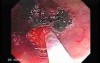 Tubulo - Villous Rectal Adenoma - Endoscopy (13 of 35)