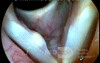 Vocal Fold Cyst