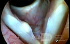 Vocal Fold Cyst