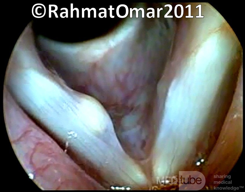 Vocal Fold Cyst