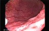 Endoscopy of severe gastritis