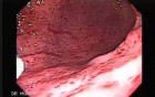 Endoscopy of severe gastritis