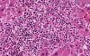 Acute myeloid leukemia - Histopathology - Liver