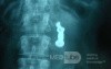 Dental Prothesis Found in the Jejuno (9 of 9)