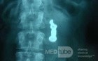 Dental Prothesis Found in the Jejuno (9 of 9)