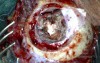 Brain tumor - Intra-Operative Photo