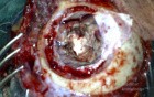 Brain tumor - Intra-Operative Photo