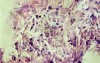 Esophageal Candidiasis Infected with Bacteria (6 of 6)