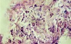 Esophageal Candidiasis Infected with Bacteria (6 of 6)