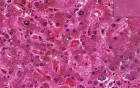 Hemochromatosis - Histopathology - Liver