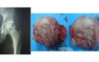 AVN femoral head