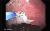 Watermelon Stomach (5 of 7) - Treatment with Argon Plasma Coagulator (APC)