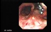 Tracheal Endoscopy - view through the thin endoscope 2/5