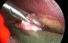 Video-Assisted Thoracoscopic Surgery 2/4