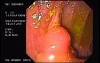 Adenocarcinoma Of The Transverse Colon - Endoscopy (1 of 9)