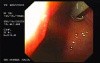 Flexible Endoscopic Suturing Device, Part 1