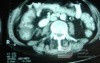 Pseudomembranous Colitis (10 of 11)
