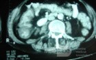 Pseudomembranous Colitis (10 of 11)