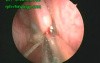 Nasal Polyp