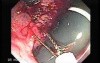 Tubulo - Villous Rectal Adenoma - Endoscopy (17 of 35)