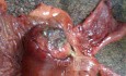 Ascending Colon Intussusception due to a Adenocarcinoma (3 of 6)