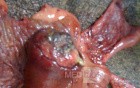 Ascending Colon Intussusception due to a Adenocarcinoma (3 of 6)