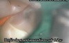 Value Of Microscopy In Conservative Dentistry