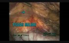 Right Radical Nephrectomy