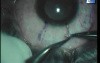 Conjunctival autograft with fibrin glue