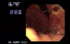 Linitis Plastica - Endoscopy
