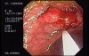 Tubulo - Villous Adenoma - Endoscopy (21 of 28)