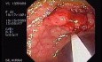Tubulo - Villous Adenoma - Endoscopy (21 of 28)