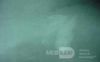 Large Gastric Varices (25 of 25)