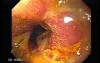 Chromatoscopy Of Barrett's Esophagus + Biopsy