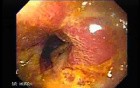 Chromatoscopy Of Barrett's Esophagus + Biopsy
