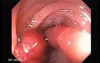 Endoscopic Appearance of Pedicled Polyp of the Descending Colon (2 of 7)