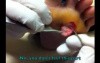 Removal of Plantar Wart, Podiatry in Smyrna, Brentwood, TN - Neuhaus Foot And Ankle