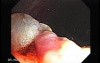 Huge Mass Of The Descending Colon (19 of 25)