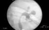 PCNL - Access Into Renal Collective System
