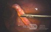 Phlegmonous Appendicitis - Intra-Operative Photo