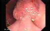 Tubulo-Villous Adenoma (4 of 6)