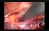 Laparoscopic Pelvic Lymphadenectomy