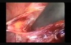 Laparoscopic Pelvic Lymphadenectomy
