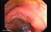 Colonic Tuberculosis Mimicking Crohn's Disease (5 of 12)