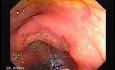 Colonic Tuberculosis Mimicking Crohn's Disease (5 of 12)