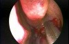 Hypoplastic Maxillary Sinus Type 2 - Endoscopic Management