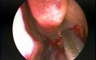 Hypoplastic Maxillary Sinus Type 2 - Endoscopic Management