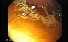 Gastrointestinal Stromal Tumor - GIST (3 of 13)